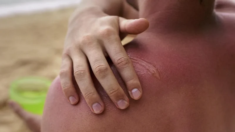 ¿Te has quemado la piel tomando el sol? Con estos consejos la volverás a tener como nueva en tiempo récord 33 Merca2.es Identificar la gravedad de la quemadura si te has quemado la piel