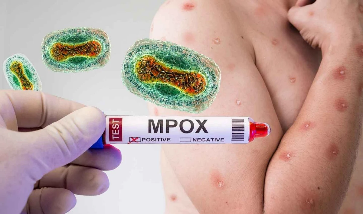 Mpox (viruela del mono): síntomas, diagnóstico y tratamiento