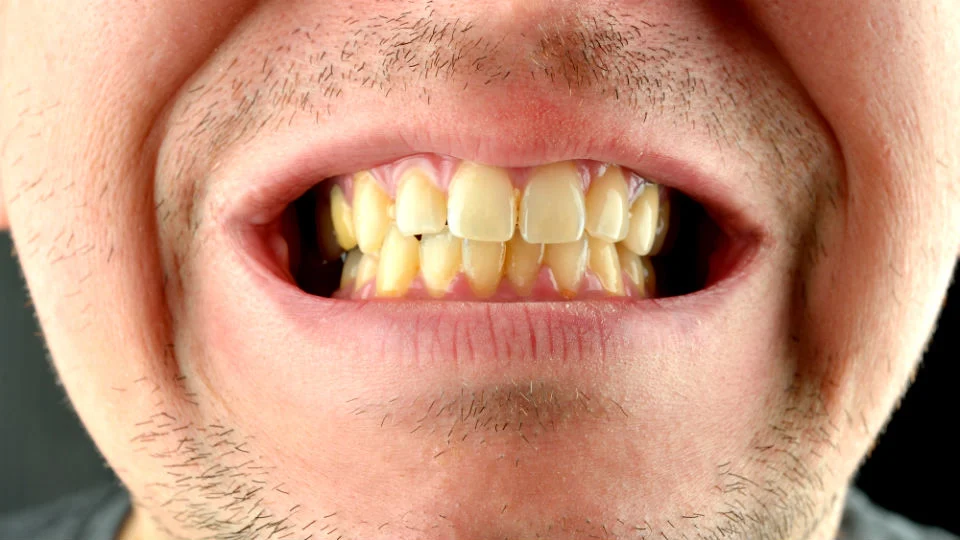 Limpiar los dientes manchados con café es posible: si lo pruebas recuperarás tu sonrisa