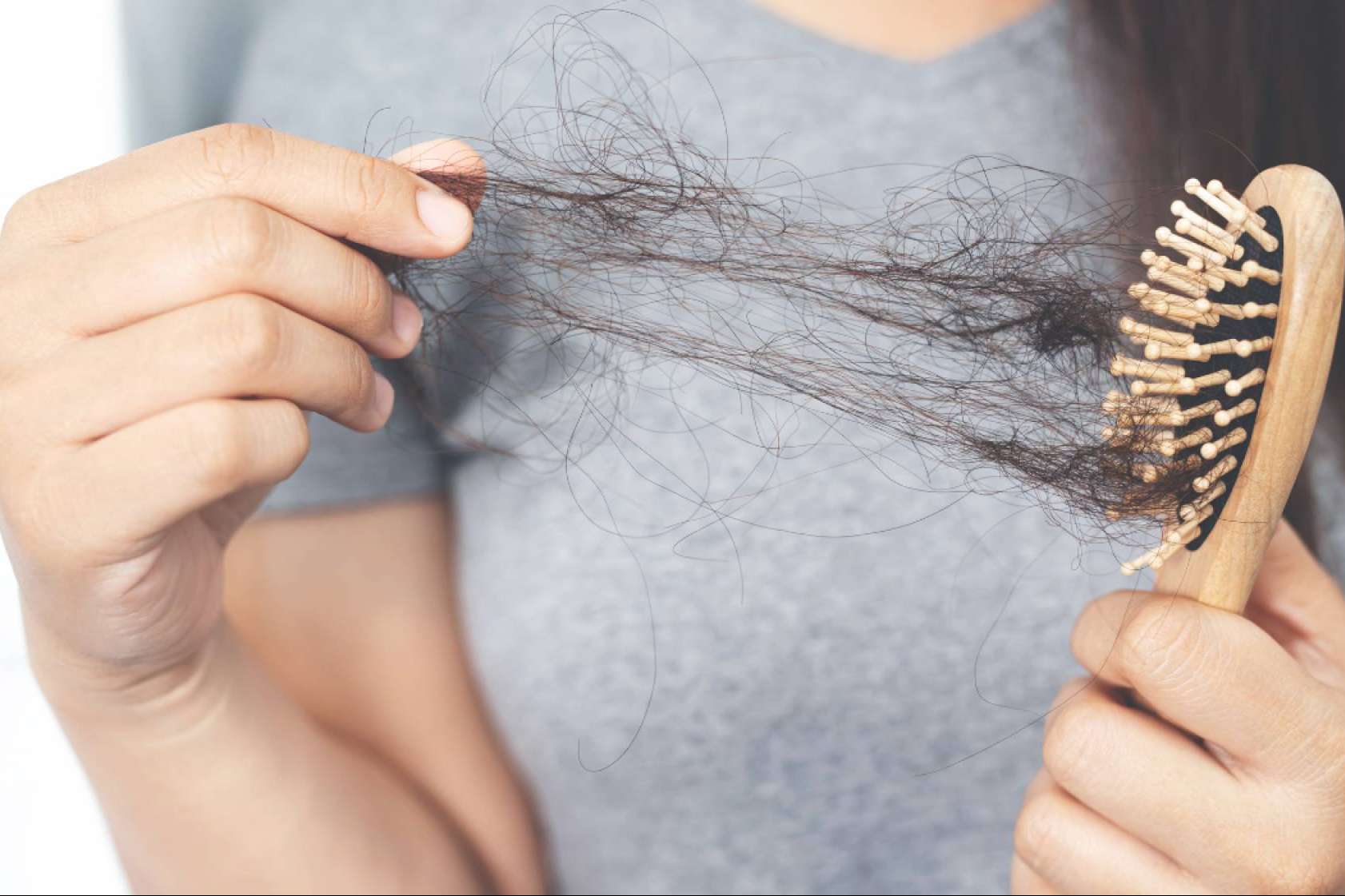Alopecia Androgénica; entendiendo y combatiendo la pérdida de cabello