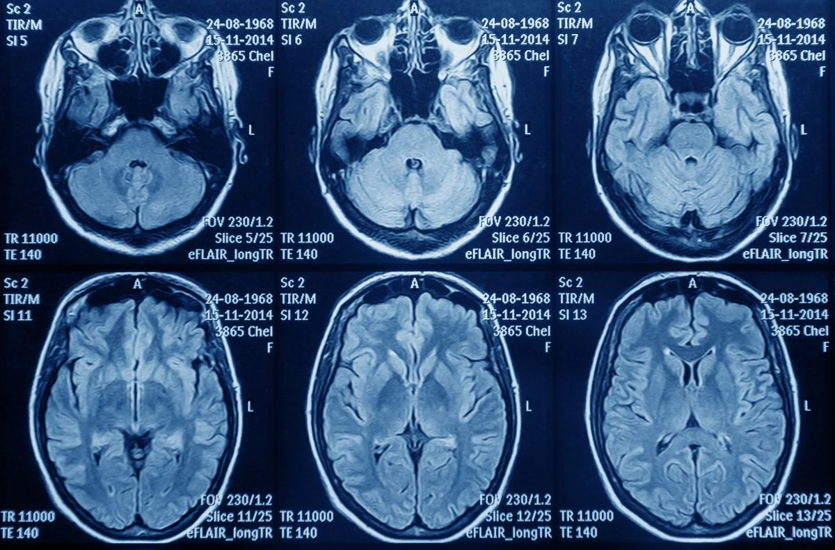 Astuce denuncia que pacientes con glioblastoma «luchan contrarreloj por recibir un tratamiento que prolongaría su supervivencia»