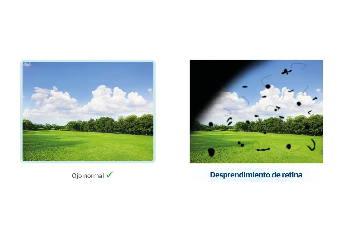Causas principales del desprendimiento de retina: ¿a quién afecta más?