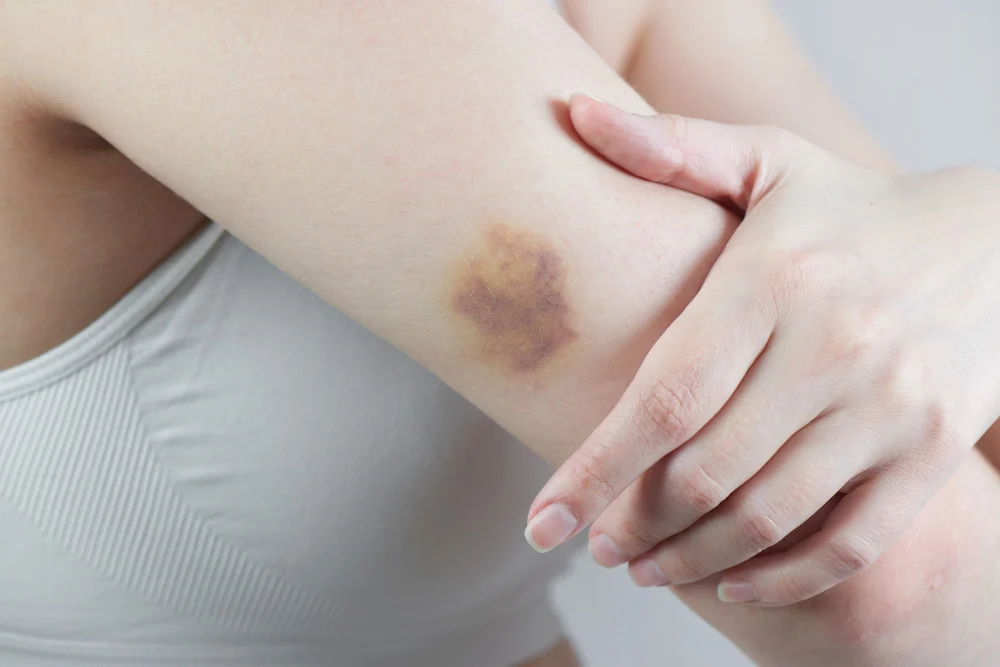 ¿Moratones fantasma sin golpearte? Tu sangre te está enviando una señal de alarma urgente
