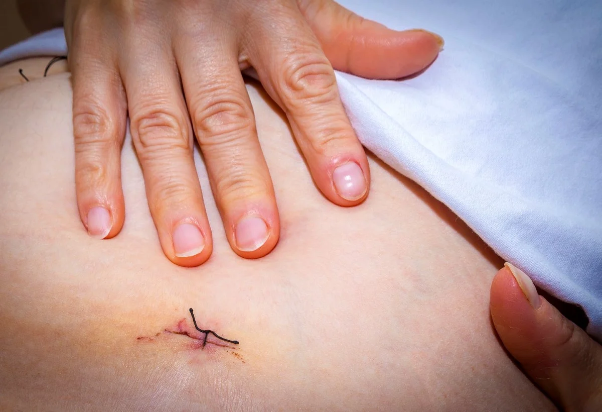cirugia endometriosis.jpg