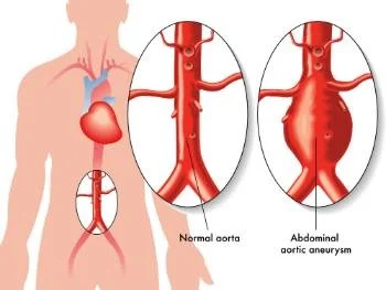 aneurisma aórtico abdominal. Fuente: Quironsalud